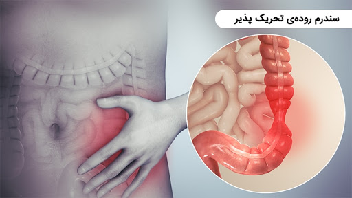 سندرم روده تحریک پذیر(IBD (Inflamatory Bowel Disease))