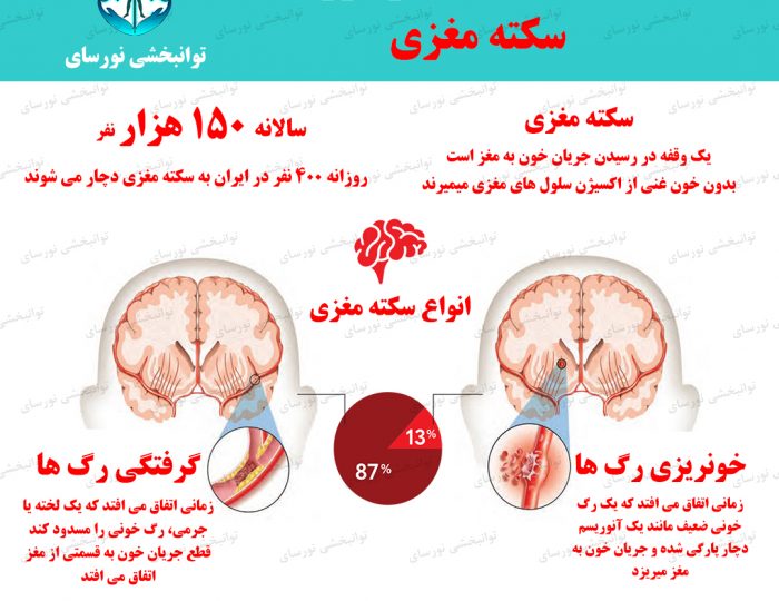 سکته مغزی چیست؟ علائم، علت، تشخیص و درمان آن