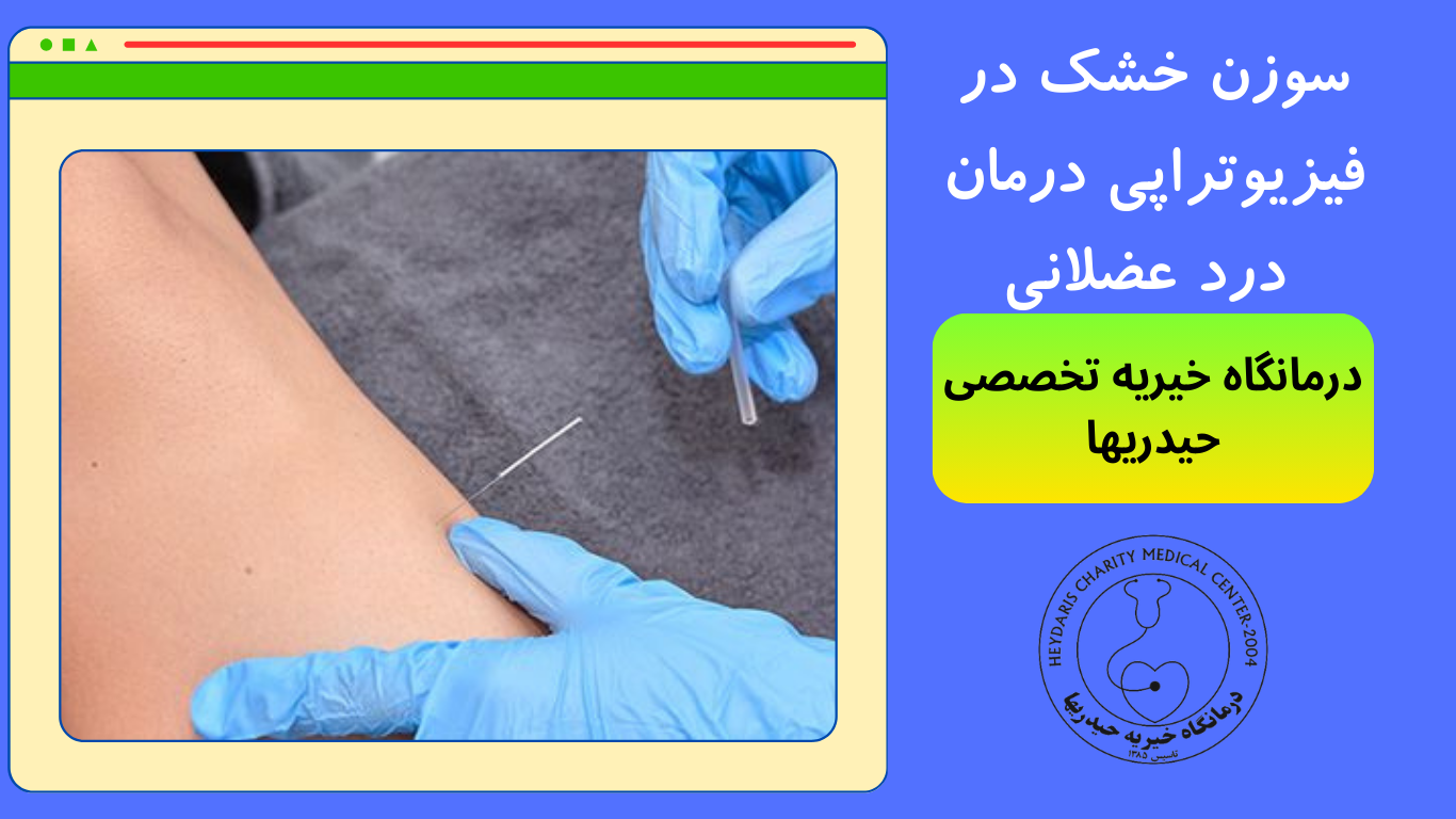 سوزن خشک در فیزیوتراپی