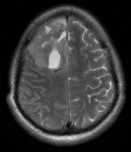 MRI در تشخیص سرطان