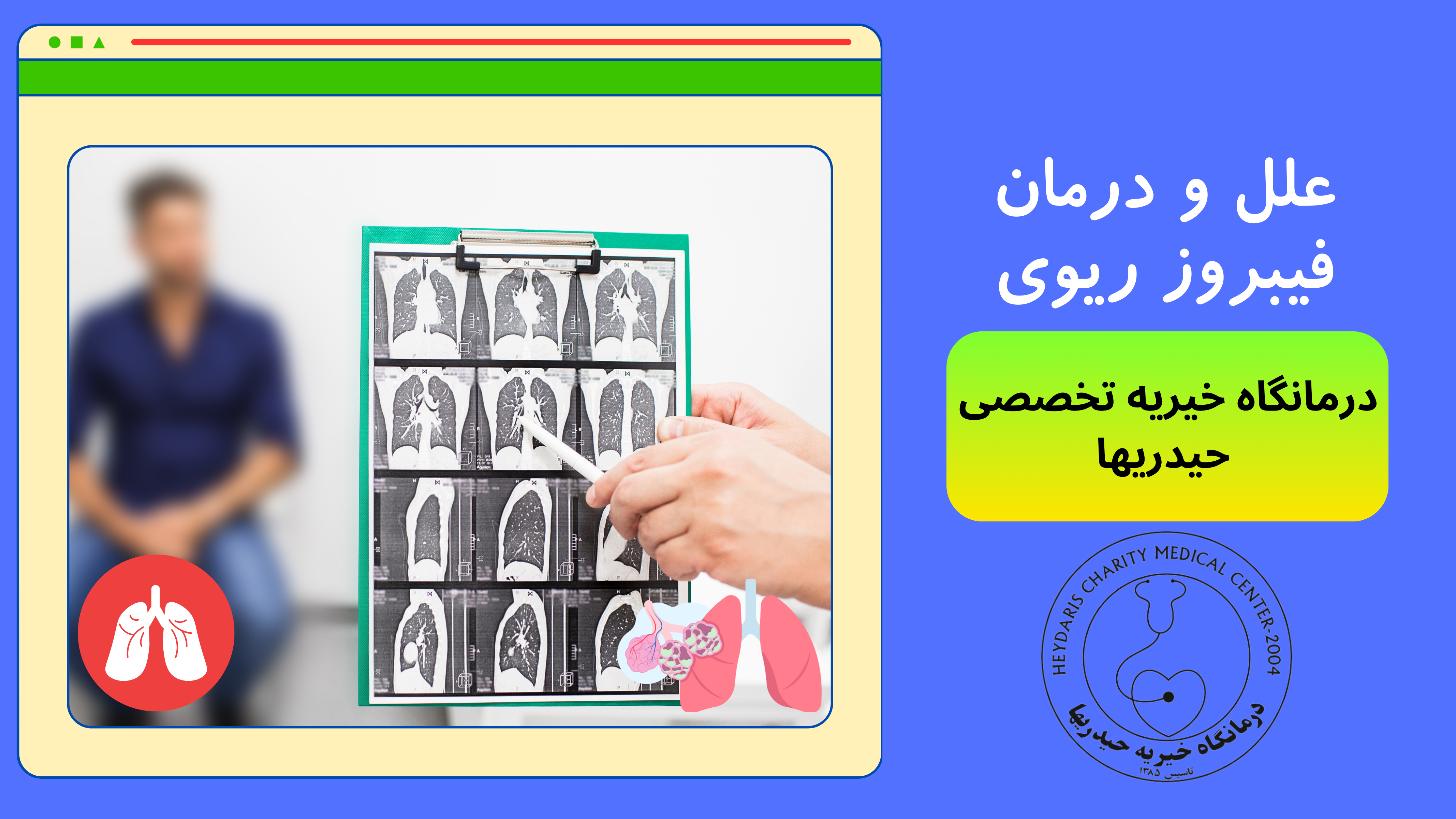 فیبروز ریوی