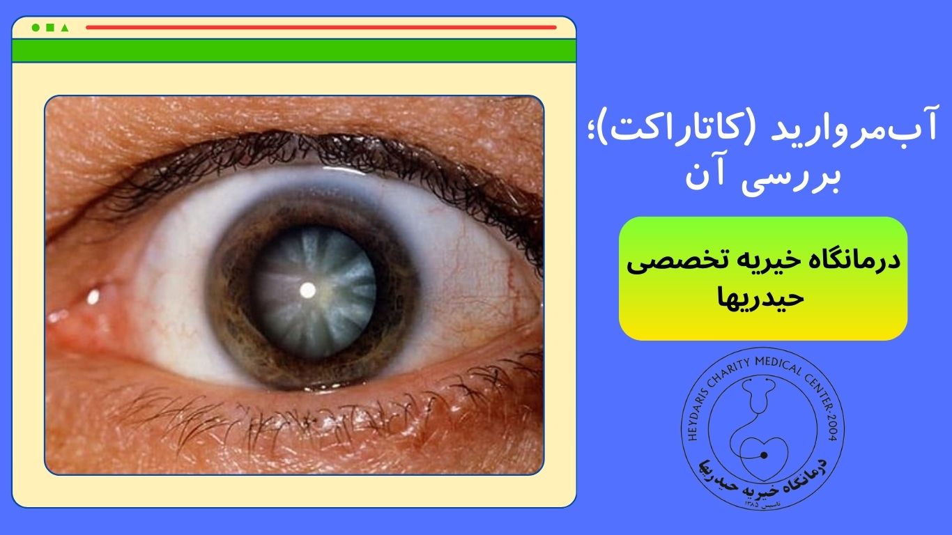 آب‌مروارید