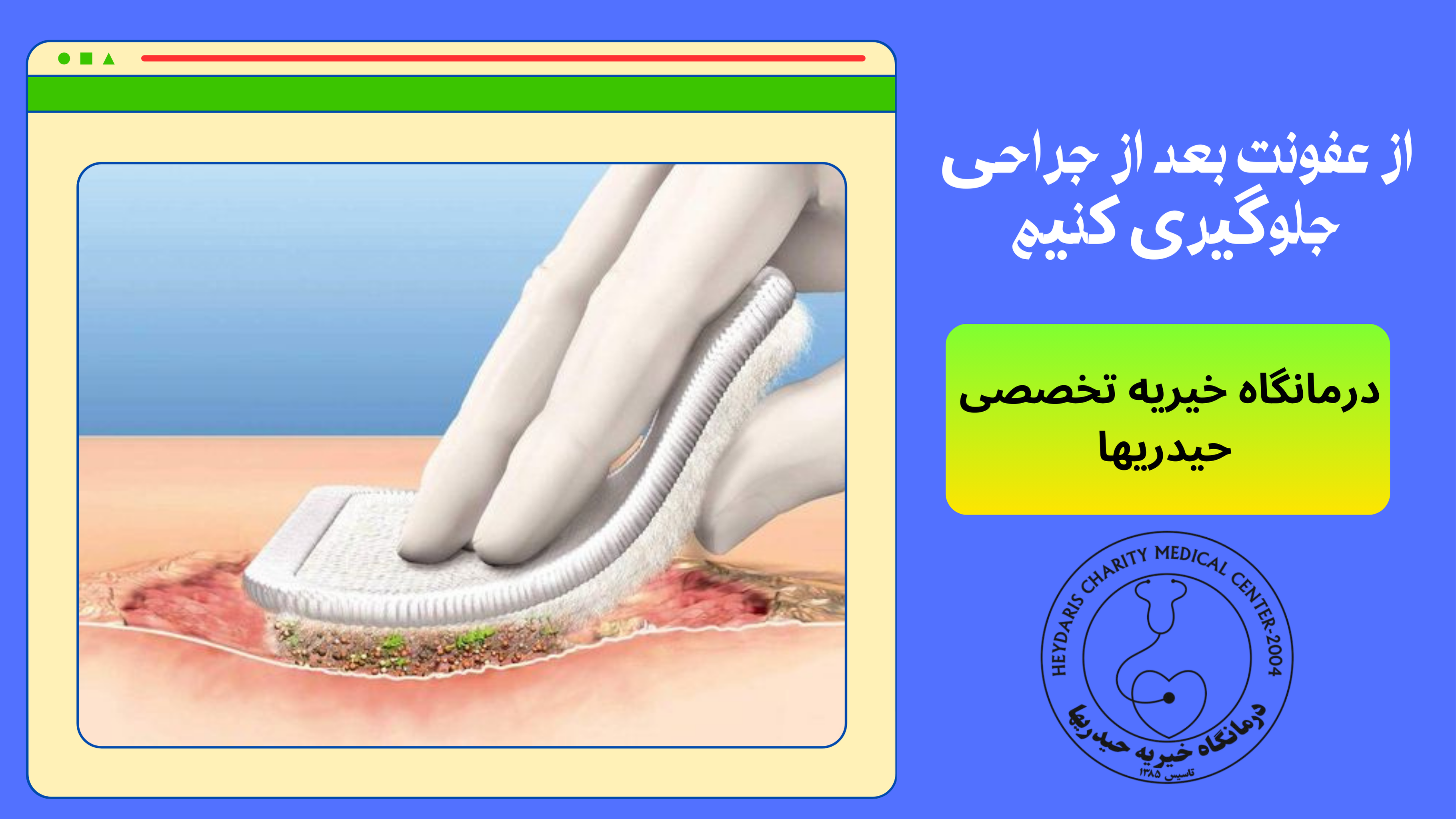 عفونت بعد از جراحی