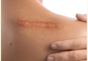 روش‌های کاهش جای زخم
