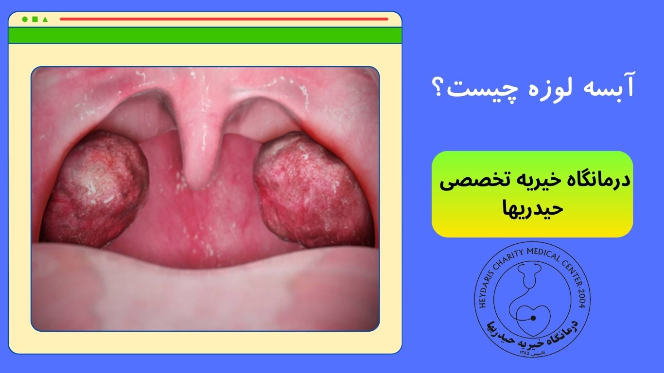 آبسه لوزه