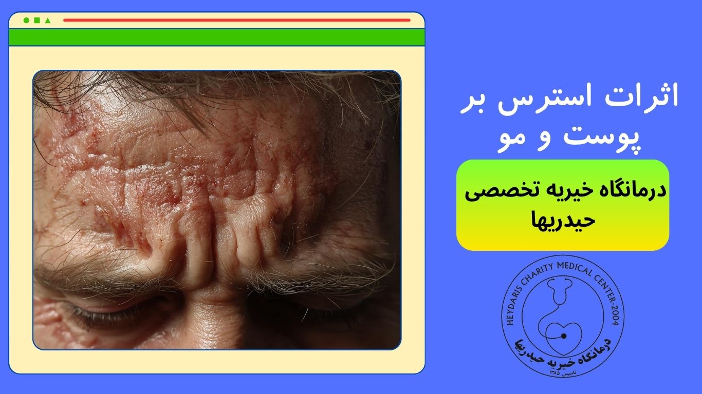 اثرات استرس بر پوست و مو 
