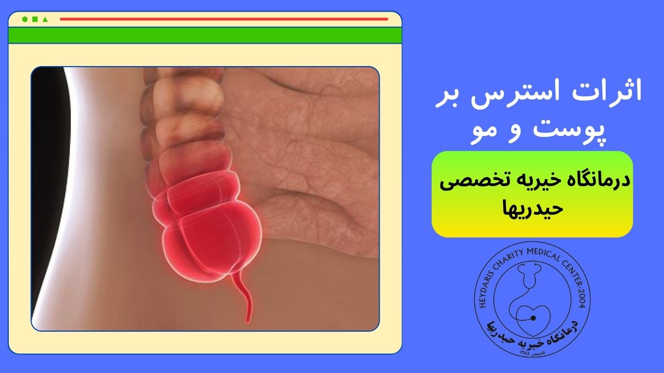 پارگی آپاندیس